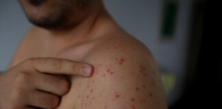 ¡Cuidado con el sarampión!